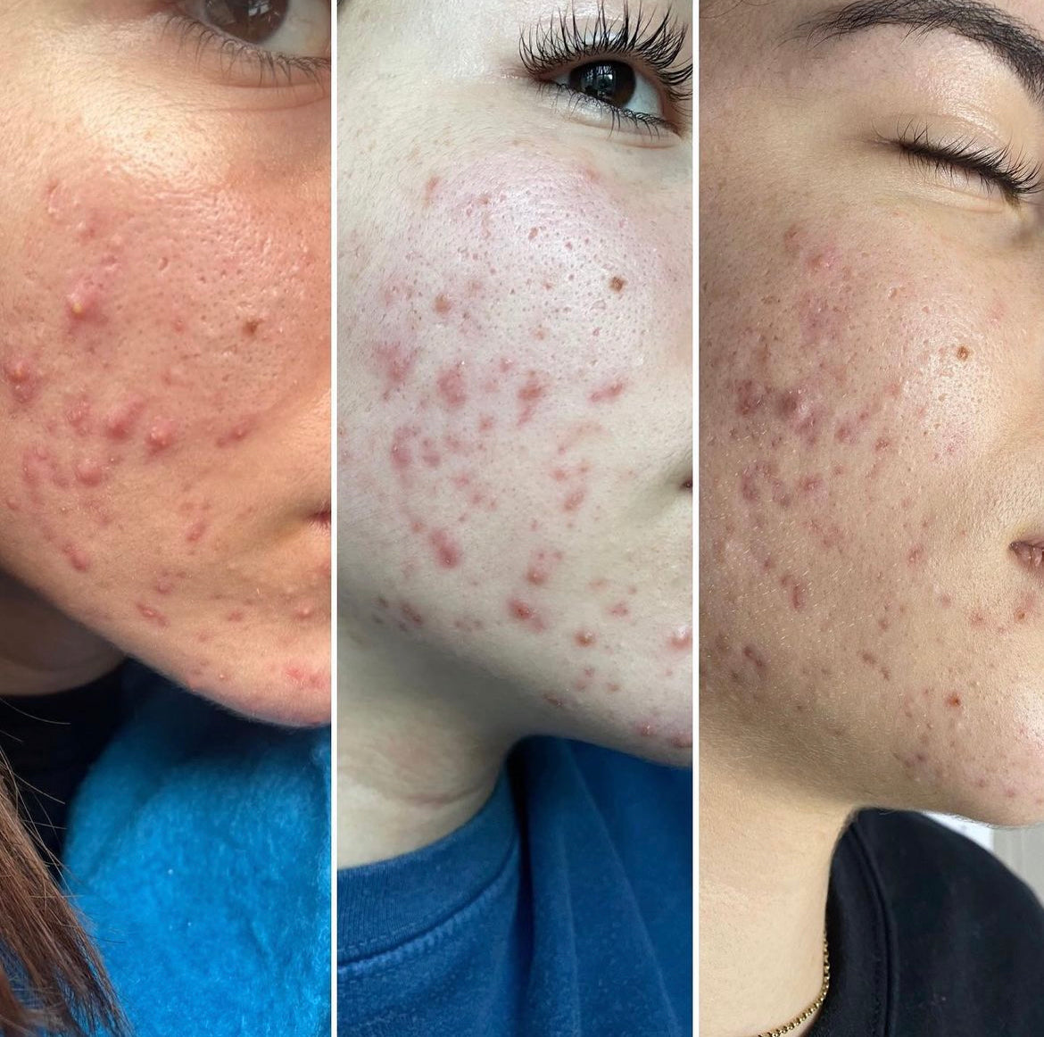 Nara Skin Acne, Pimples and Spot Treatment Set