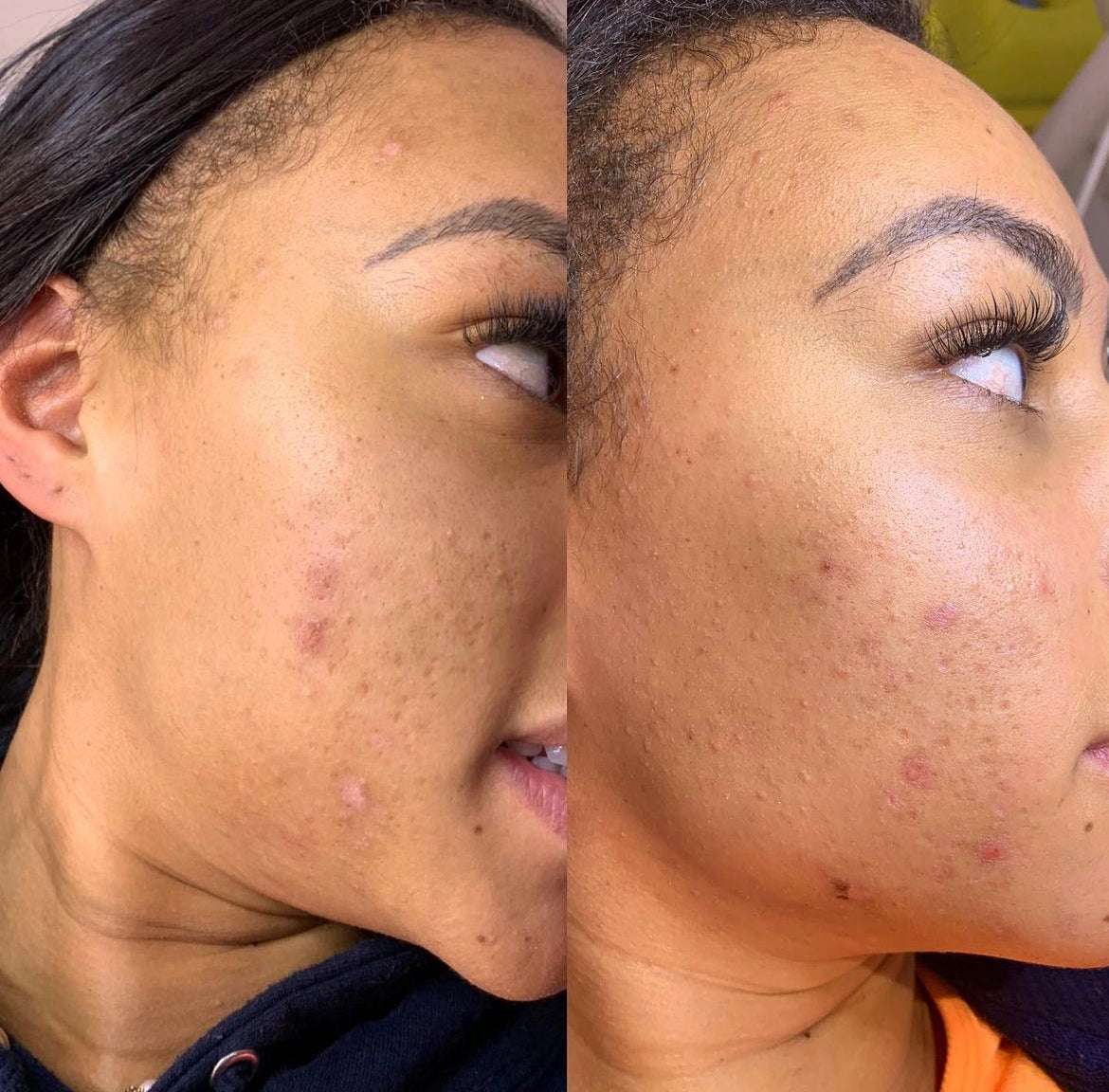 Nara Skin Acne, Pimples and Spot Treatment Set